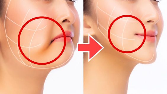 buccal fat removal