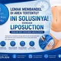 Lemak membandel di area tertentu dan solusi liposuction untuk body contouring di Liposuction Jakarta