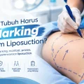 Marking sebelum liposuction atau sedot lemak di Jakartamarking-sebelum-liposuction-sedot-lemak-jakarta